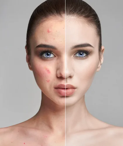 pimples-acne-woman-face-before-after